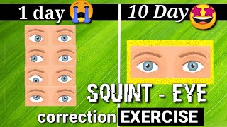 Squint Eye treatment NATURALLY with exercises at Home [upl. by Mazurek]