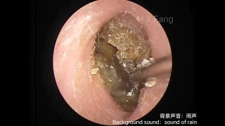 Ear wax and Dead skin removal耳垢和死皮清理20230821 [upl. by Buhler170]