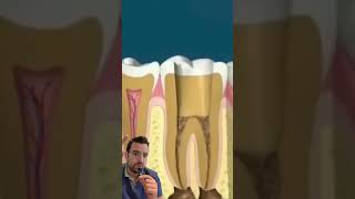 La DEVITALISATION DENTAIRE expliquée et commentée en 3D dentiste carie medical [upl. by Youngman43]