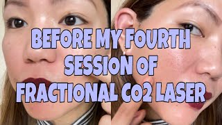 BEFORE MY FOURTH SESSION OF FRACTIONAL CO2  INTRO LANG DAPAT TO E 🤣  LAST JULY 15 2022  VLOG 18 [upl. by Mahalia]