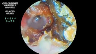 采耳哥External auditory canal cholesteatoma and fungal steatoma ｜585 [upl. by Enaxor]