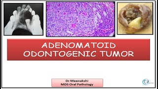 Adenomatoid odontogenic Tumor [upl. by Eihcra402]