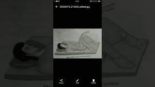 Lithotomy position [upl. by Brittney332]