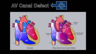 Fetal Echocardiography AV Canal Defect [upl. by Clements]