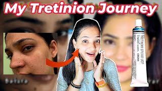 How RetinolTretinoin Transformed my Skin in just 2 Months A MustSee Indian YouTuber Anmol [upl. by Siroved]