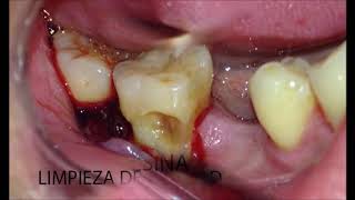 Tratamiento de caries radicular Interrelación PeriodonciaOperatoria dental [upl. by Judah]