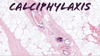 Calciphylaxis deadly complication of chronic kidney disease renal failure pathology dermpath [upl. by Valenta672]