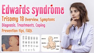 Edwards syndrome trisomy 18 causes symptoms diagnosis treatment screening prevention FAQ [upl. by Nilved]