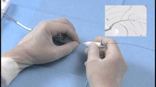 Angioplasty technique manipulation of a guide wire [upl. by Nylissej768]