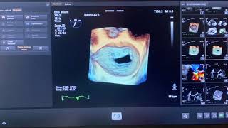 EVALUATION OF MITRAL VALVE AT TRANSESOPHAGEAL ECHOCARDIOGRAPHY TEE [upl. by Eidoc]