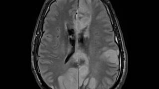 Intracranial Vasospasm [upl. by Jeffries]