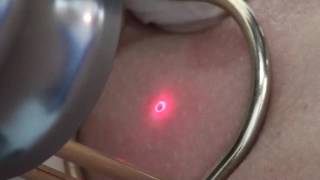 Mole removal fractional CO2 laser [upl. by Anipsed]