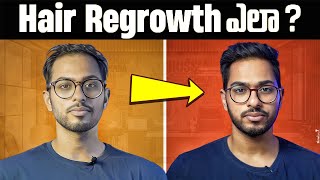 How I got my HAIR back  FULL GUIDE on Minoxidil Telugu [upl. by Eiznekam]