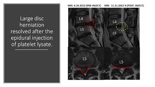 Regenexx MRI Before After Compliation Video [upl. by Oberg]