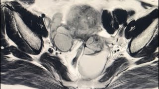 MRI Female Pelvis 37YF  Nabothian cyst [upl. by Gnort]