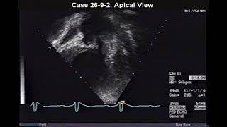 P594 Clip 269 Eisenmenger Syndrome [upl. by Leonhard]