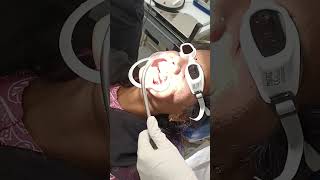 Surgical excision of fibroma from maxillary gingiva with laser [upl. by Annirok]