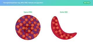 How to evaluate HbA1c results when HbA is absent [upl. by Nedra]