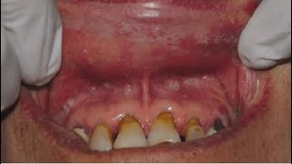 Association of Systemic Drugs in Oral Lichenoid Reaction [upl. by Sekofski]