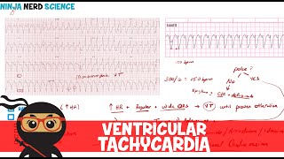 Rate and Rhythm  Ventricular Tachycardia [upl. by Panayiotis]