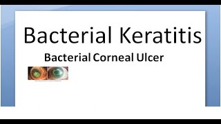 Ophthalmology 111 a Bacterial Keratitis Corneal Ulcer Cornea Bacteria Infective Hypopyon infection [upl. by Monafo]