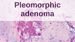 Pleomorphic Adenoma of Salivary Gland [upl. by Nydroj379]