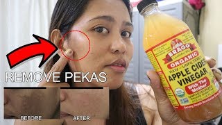 PAANO MATANGAL ANG PEKAS O MELASMA GAMIT ANG APPLE CIDER VINEGAR TIPID AT NATURAL NANPARAAN [upl. by Aynik]