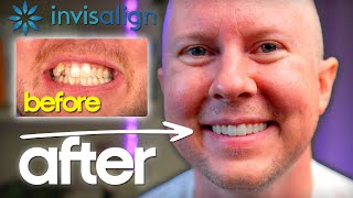 Invisalign REVIEW – What They DON’T Tell You About Straightening Teeth [upl. by Treblihp]