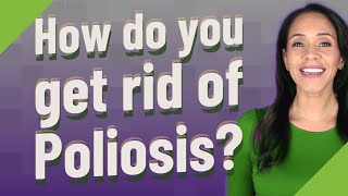 How do you get rid of Poliosis [upl. by Rovit]