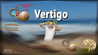 Vertigo Causes Pathophysiology and Treatments Animation [upl. by Afaw]