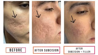 Subcision  Filler for Acne Scars [upl. by Michon231]