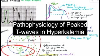 Hyperkalemia Explained Pathophysiology of Peaked TWaves [upl. by Elfont6]