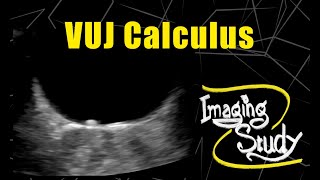 Vesicoureteric Junction VUJ Calculus  Ultrasound  Case 72 [upl. by Austine]