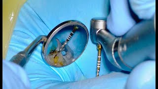 Root Canal Procedure  Top 5 Secrets [upl. by Quinton54]