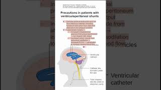 Precautions in patients with ventriculoperitoneal shunts [upl. by Arretal]