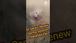 Dermoid cyst removal [upl. by Calysta]