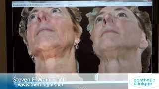 Infini before and after results 3D Photos Discussed by Dr Steven Weiner [upl. by Bohannon]