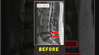 What Happens in a Herniated Disc [upl. by Arianne]