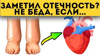 Прежде чем есть химию при отёках каждый должен узнать это Причина отёков сердце [upl. by Marder797]