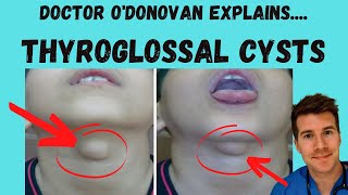 Explaining Thyroglossal Cysts  Origins Diagnosis and Management  With Dr ODonovan [upl. by Annav184]