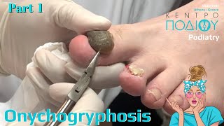 Onychogryphosis 1NailsΟνυχογρύπωσηΠοδιατρικήΚέντρο Ποδιού PodiatryΠοδίατροςΠοδολόγοςΠοδολογία [upl. by Abrahamsen]