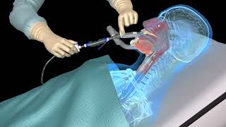 Suctioning the endotracheal tube  medical animation [upl. by Radborne668]