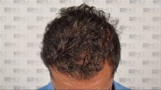 ASMED  Dr Koray Erdogan  5506 Grafts FUE hairtransplant hairtransplantturkey [upl. by Eicam]