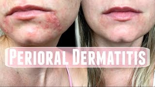 Perioral Dermatitis How I treated it [upl. by Aicilet]