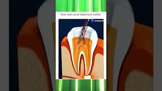 Everything You Need to Know About Root Canal Treatment  Dental Care Explained [upl. by Namie]