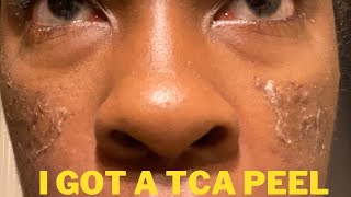 I got a 15 percent tca peel  my chemical peel experience [upl. by Haff]