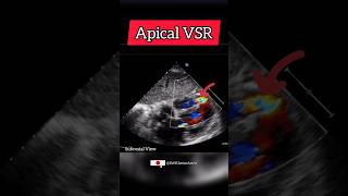 Post MI apical Ventricular Septal Rupture VSR on Echocardiography cardiology heart [upl. by Alabaster450]