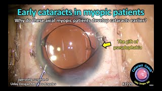 CataractCoach™ 2220 early cataracts in myopic patients  why [upl. by Elleryt255]