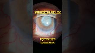 Підвивих сублюксація кришталика  Subluxation of the lens cataract катаракта [upl. by Erodavlas]