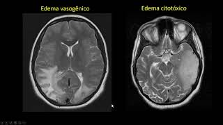 Edema cerebral [upl. by Tamer260]